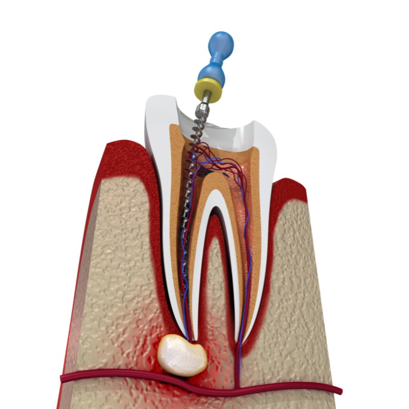 endodoncia-tratamiento