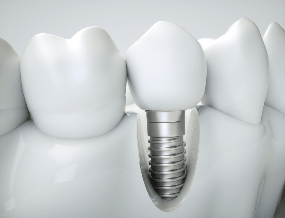 implante-dental-valencia