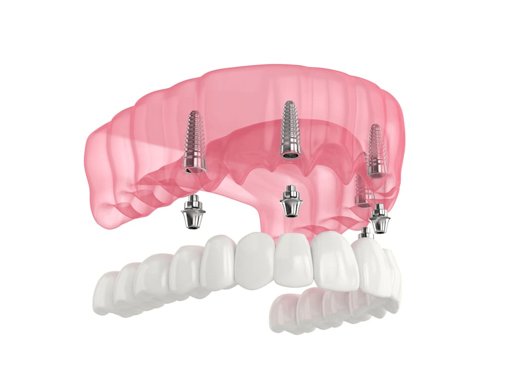 implantes-dentales-carga-inmediata