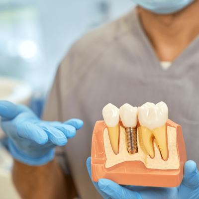 El implante dental precio depende de varios aspectos