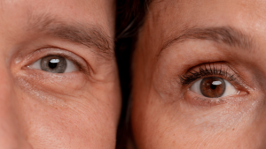 ventajas de la blefaroplastia superior