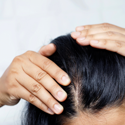 Mesoterapia capilar e injerto de pelo