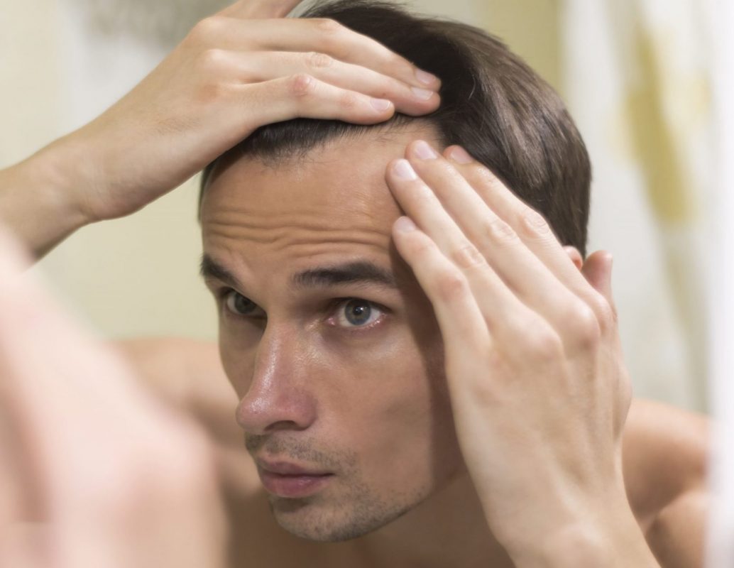 como nos afecta la alopecia