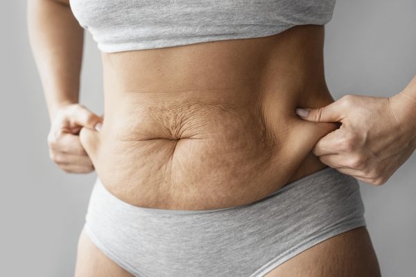abdominoplastia y sobrepeso
