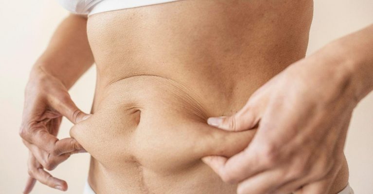 liposucción abdominal y perder grasa